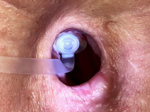 Stoma with provox plug step 4 insertion