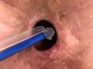 Stoma with provox plug step 3 insertion