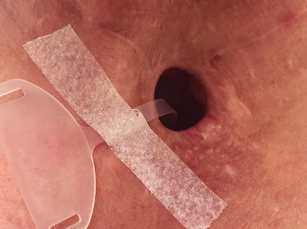 Stoma with provox plug step 5 insertion