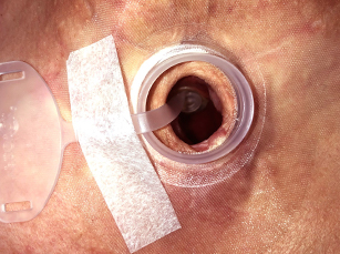 Stoma with provox plug step 6 insertion